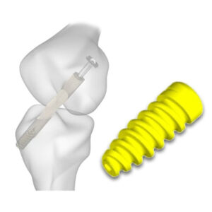 Parafuso De Interferência em Titânio